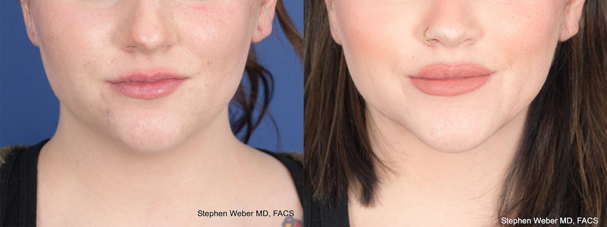 Liposuction Before & After Gallery - Patient 558039 - Image 1
