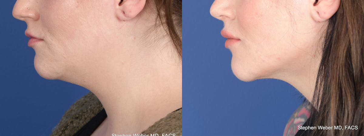 Liposuction Before & After Gallery - Patient 558039 - Image 2