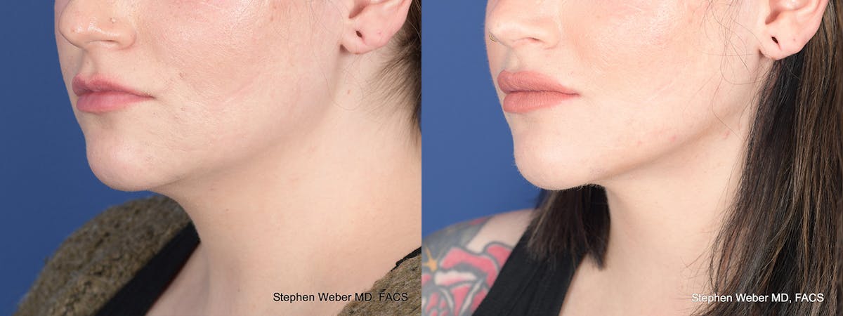 Liposuction Before & After Gallery - Patient 558039 - Image 3