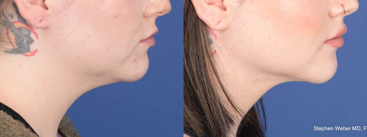 Liposuction Before & After Gallery - Patient 558039 - Image 4