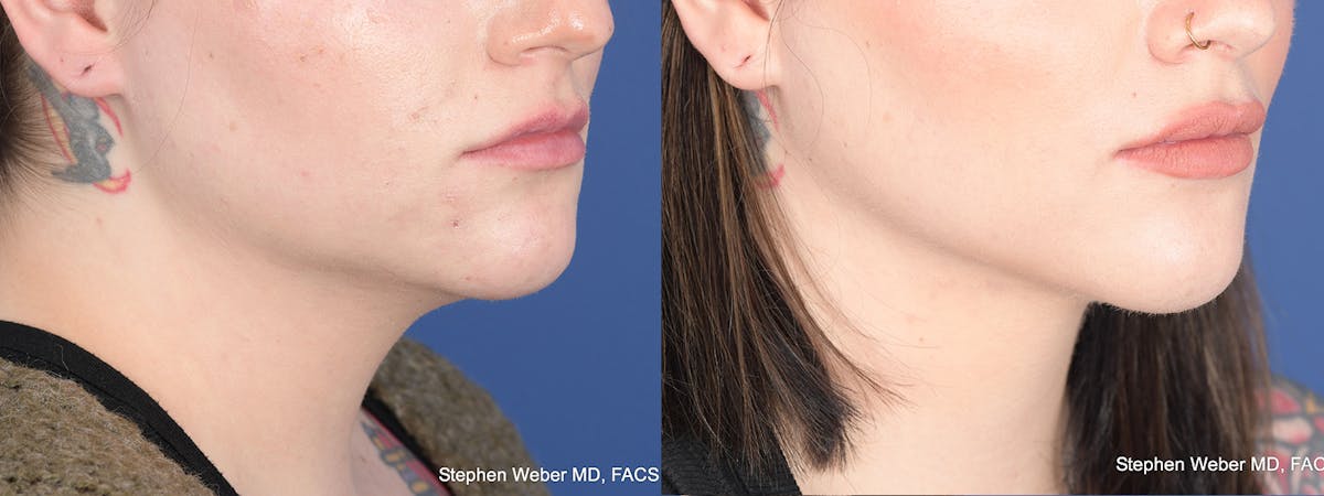 Liposuction Before & After Gallery - Patient 558039 - Image 5