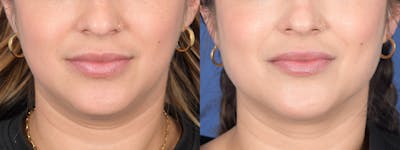 Liposuction Before & After Gallery - Patient 275313 - Image 1