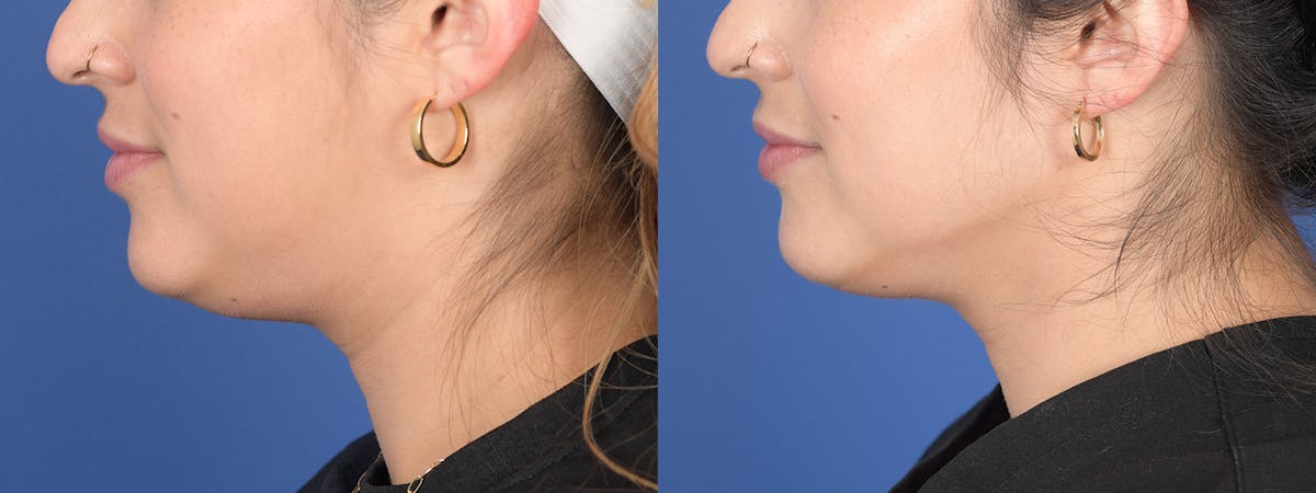 Liposuction Before & After Gallery - Patient 275313 - Image 2