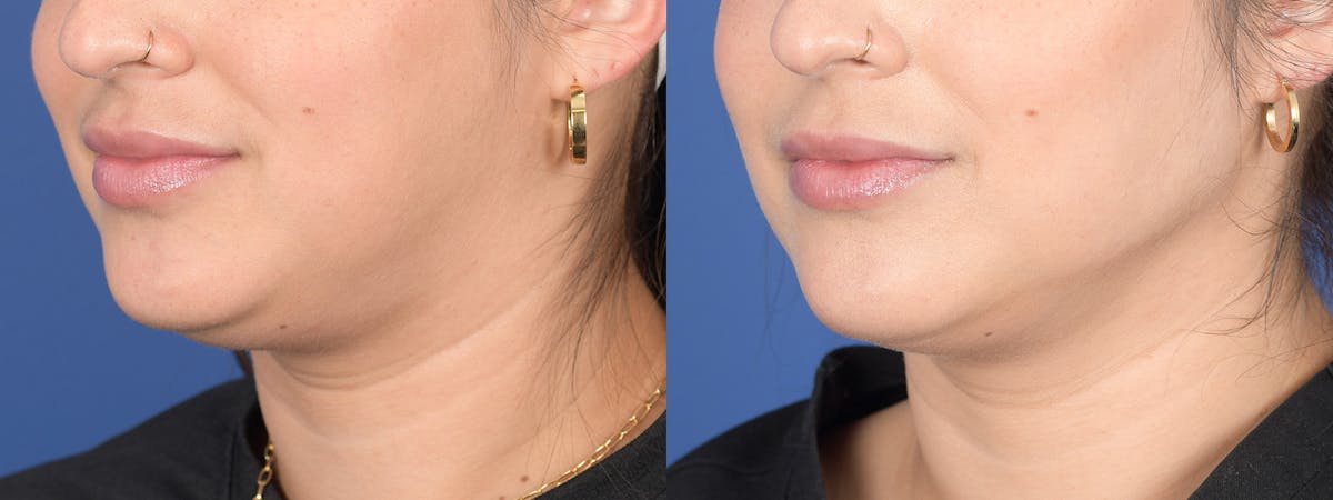 Liposuction Before & After Gallery - Patient 275313 - Image 3