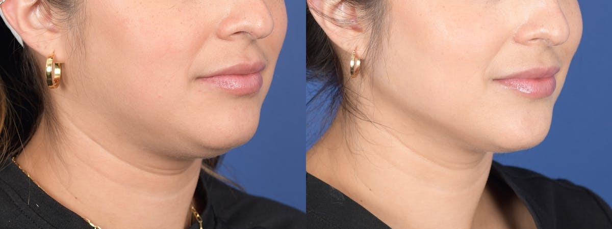 Liposuction Before & After Gallery - Patient 275313 - Image 4