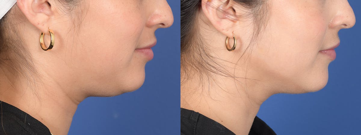 Liposuction Before & After Gallery - Patient 275313 - Image 5