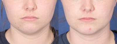 Liposuction Before & After Gallery - Patient 277597 - Image 1