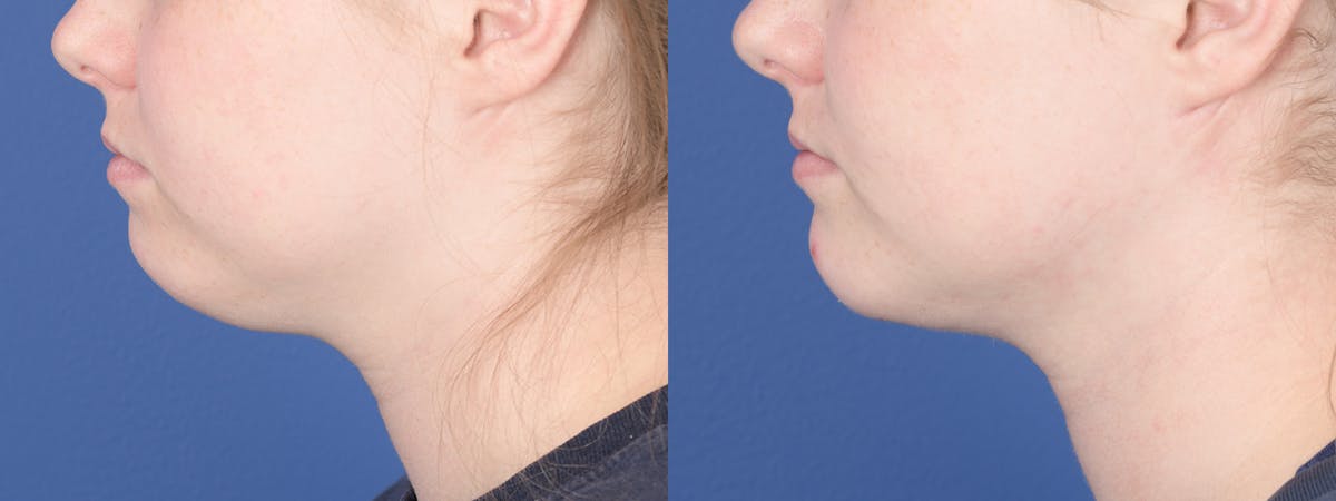 Liposuction Before & After Gallery - Patient 277597 - Image 2
