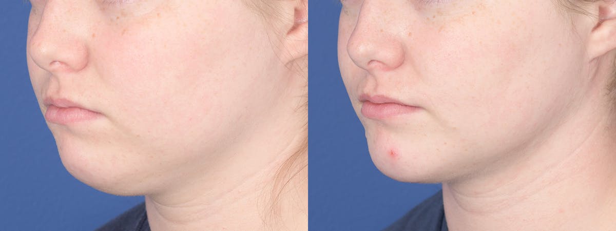 Liposuction Before & After Gallery - Patient 277597 - Image 3