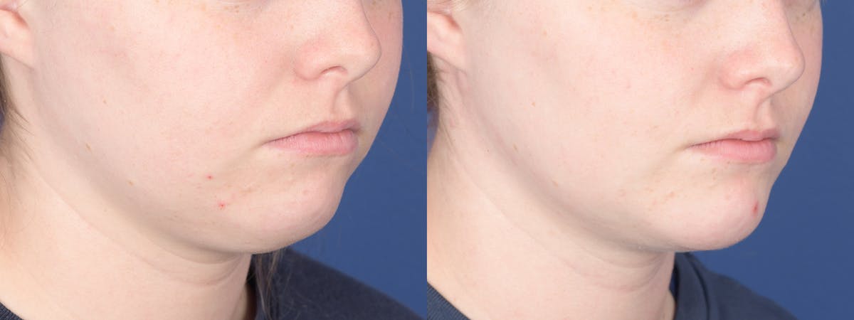 Liposuction Before & After Gallery - Patient 277597 - Image 4