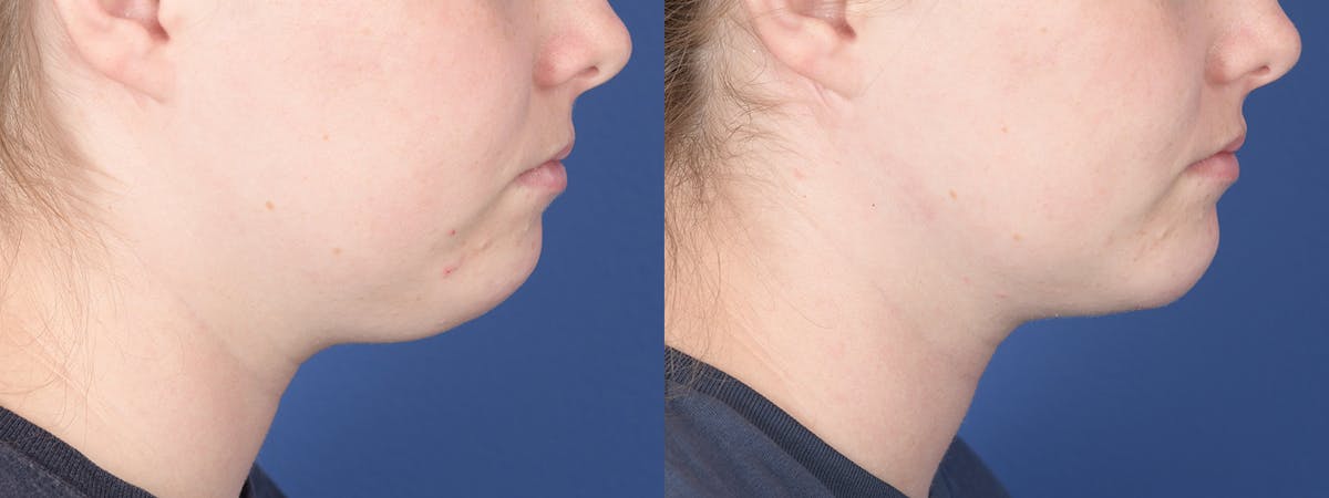 Liposuction Before & After Gallery - Patient 277597 - Image 5