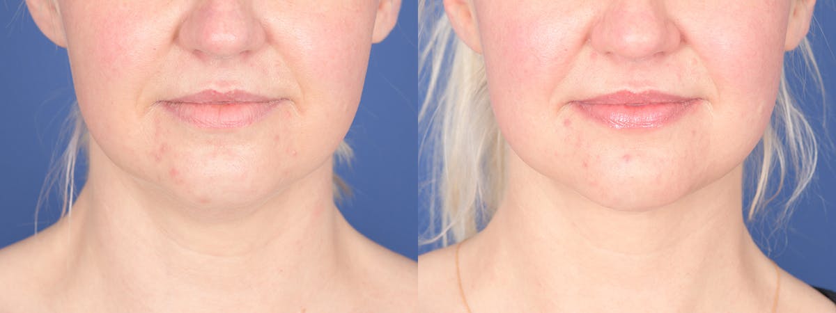 Liposuction Before & After Gallery - Patient 162139 - Image 1
