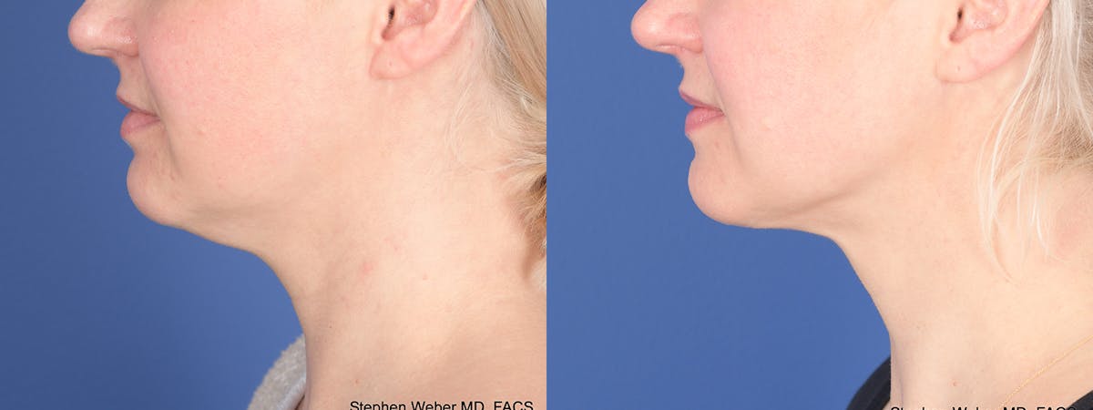 Liposuction Before & After Gallery - Patient 162139 - Image 2