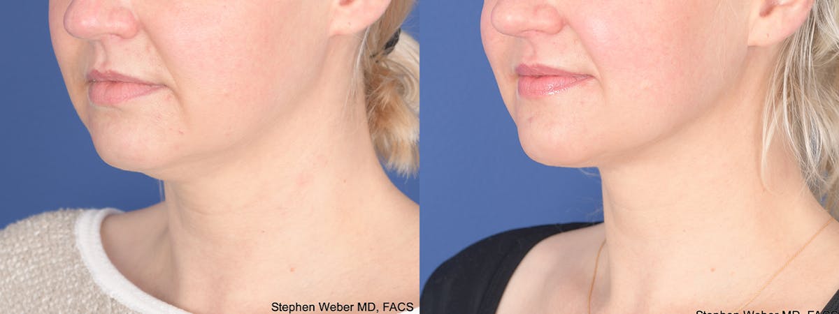 Liposuction Before & After Gallery - Patient 162139 - Image 3