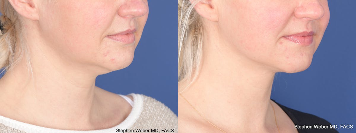 Liposuction Before & After Gallery - Patient 162139 - Image 4