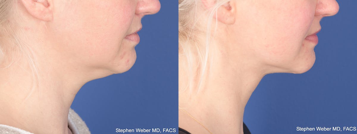 Liposuction Before & After Gallery - Patient 162139 - Image 5