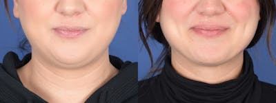 Liposuction Before & After Gallery - Patient 200804 - Image 1