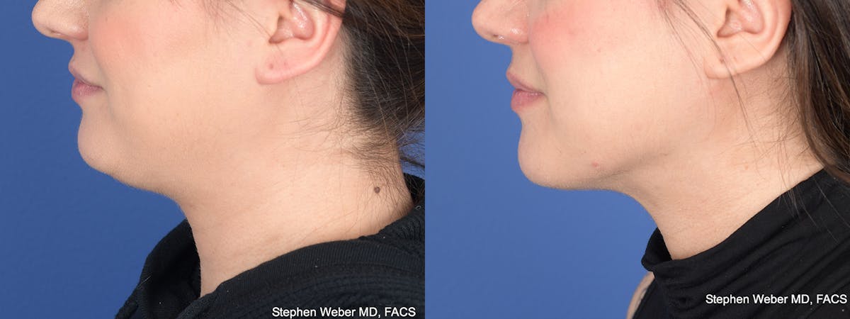 Liposuction Before & After Gallery - Patient 200804 - Image 2