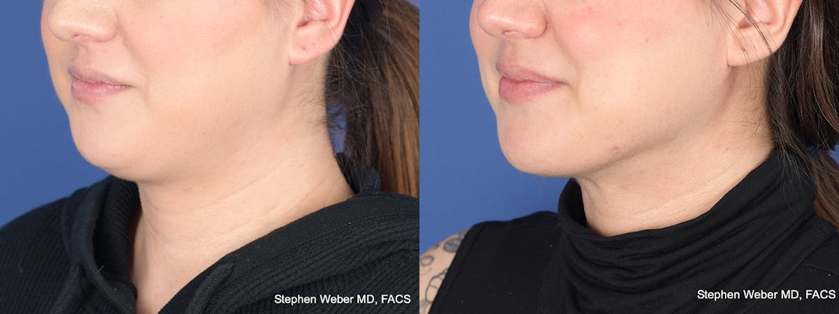 Liposuction Before & After Gallery - Patient 200804 - Image 3