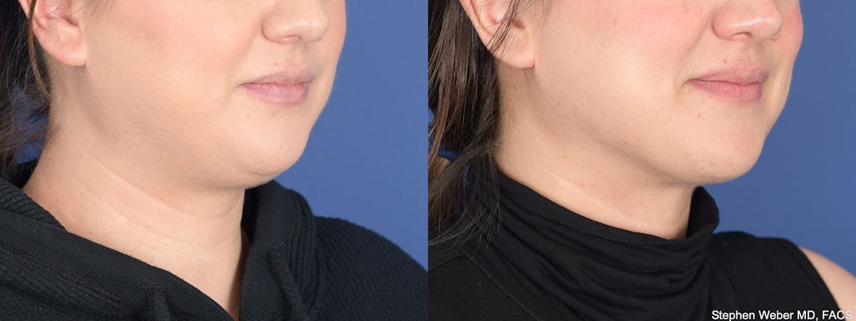 Liposuction Before & After Gallery - Patient 200804 - Image 4