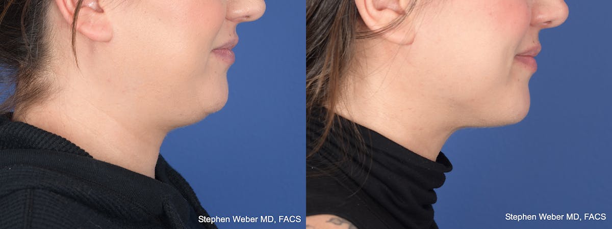Liposuction Before & After Gallery - Patient 200804 - Image 5