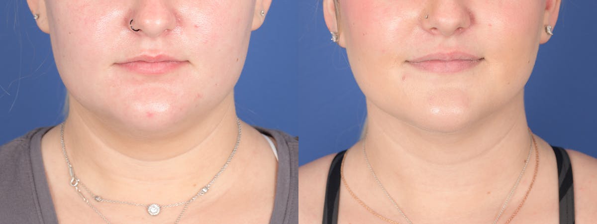 Liposuction Before & After Gallery - Patient 219315 - Image 1
