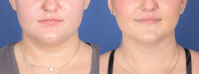 Liposuction Before & After Gallery - Patient 219315 - Image 1