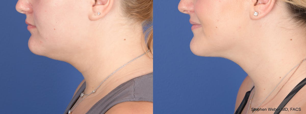 Liposuction Before & After Gallery - Patient 219315 - Image 2
