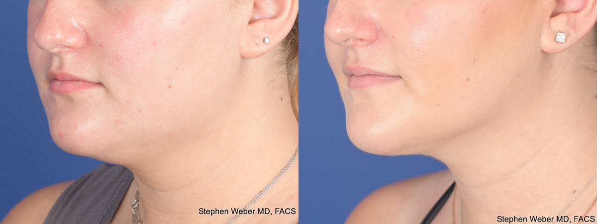 Liposuction Before & After Gallery - Patient 219315 - Image 3