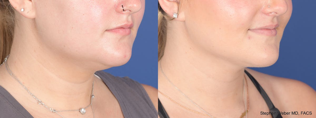 Liposuction Before & After Gallery - Patient 219315 - Image 4