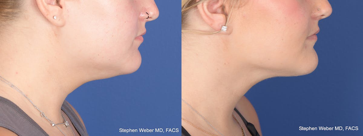 Liposuction Before & After Gallery - Patient 219315 - Image 5