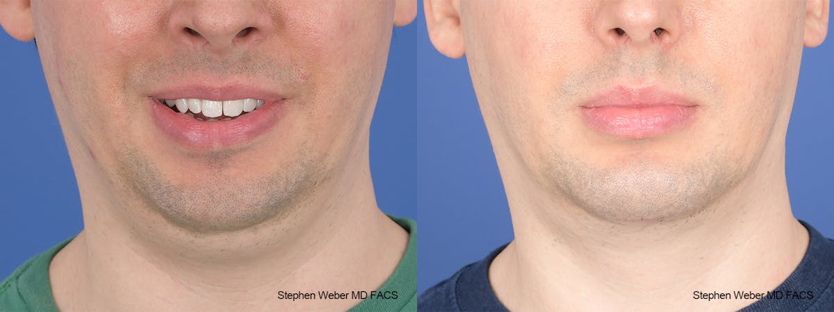 Liposuction Before & After Gallery - Patient 338871 - Image 1