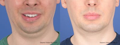 Liposuction Before & After Gallery - Patient 338871 - Image 1