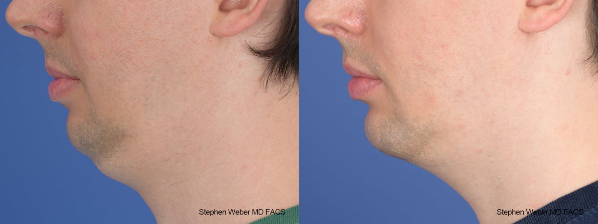 Liposuction Before & After Gallery - Patient 338871 - Image 2