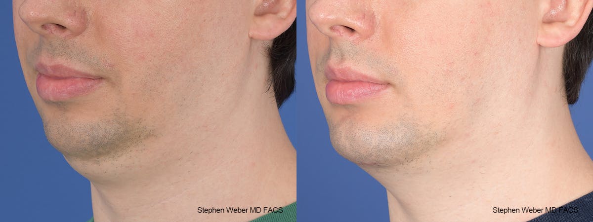 Liposuction Before & After Gallery - Patient 338871 - Image 3