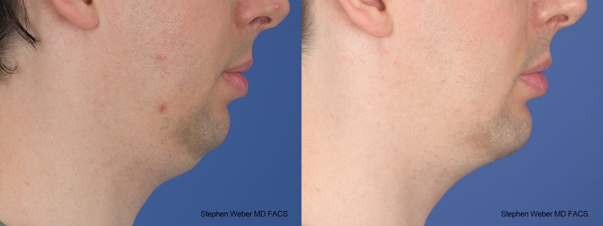 Liposuction Before & After Gallery - Patient 338871 - Image 4