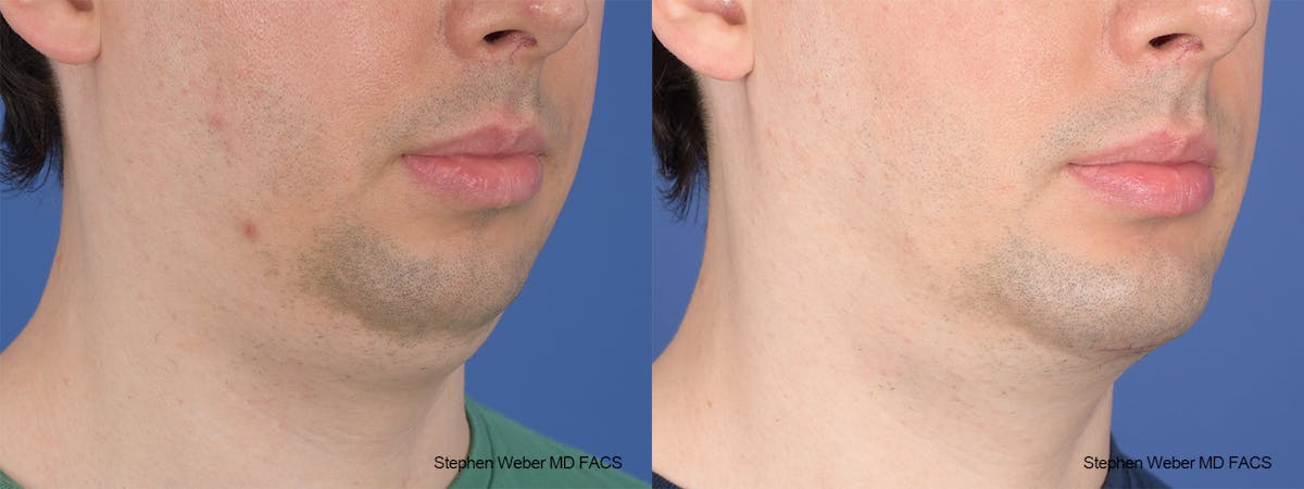 Liposuction Before & After Gallery - Patient 338871 - Image 5