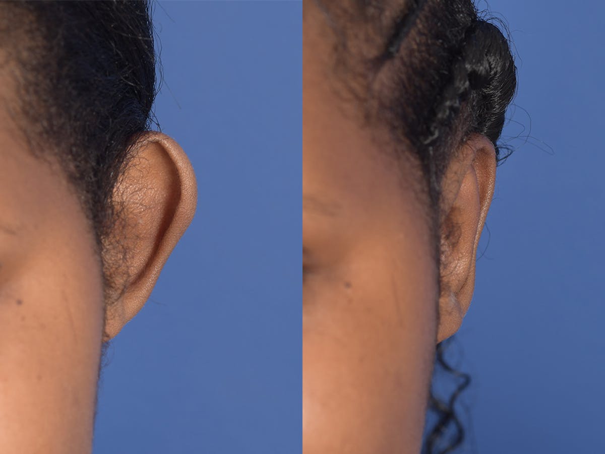 Otoplasty Before & After Gallery - Patient 221385 - Image 1
