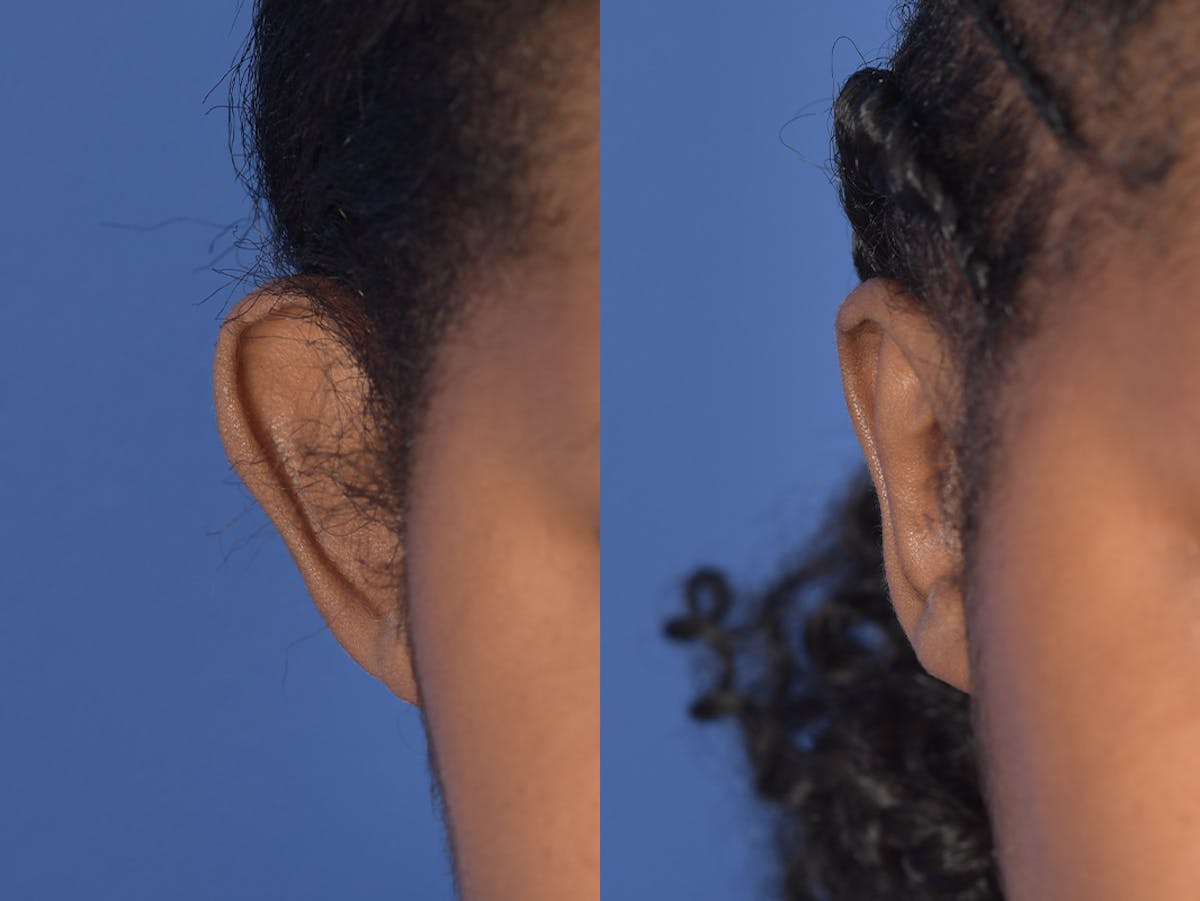 Otoplasty Before & After Gallery - Patient 221385 - Image 2
