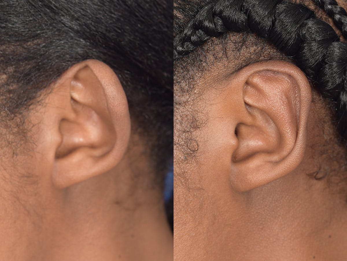 Otoplasty Before & After Gallery - Patient 221385 - Image 3
