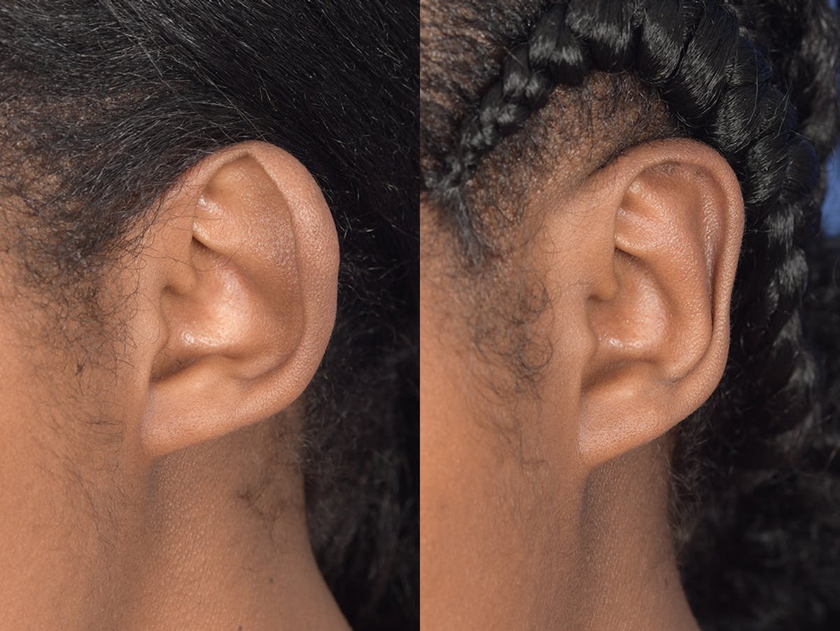 Otoplasty Before & After Gallery - Patient 221385 - Image 4
