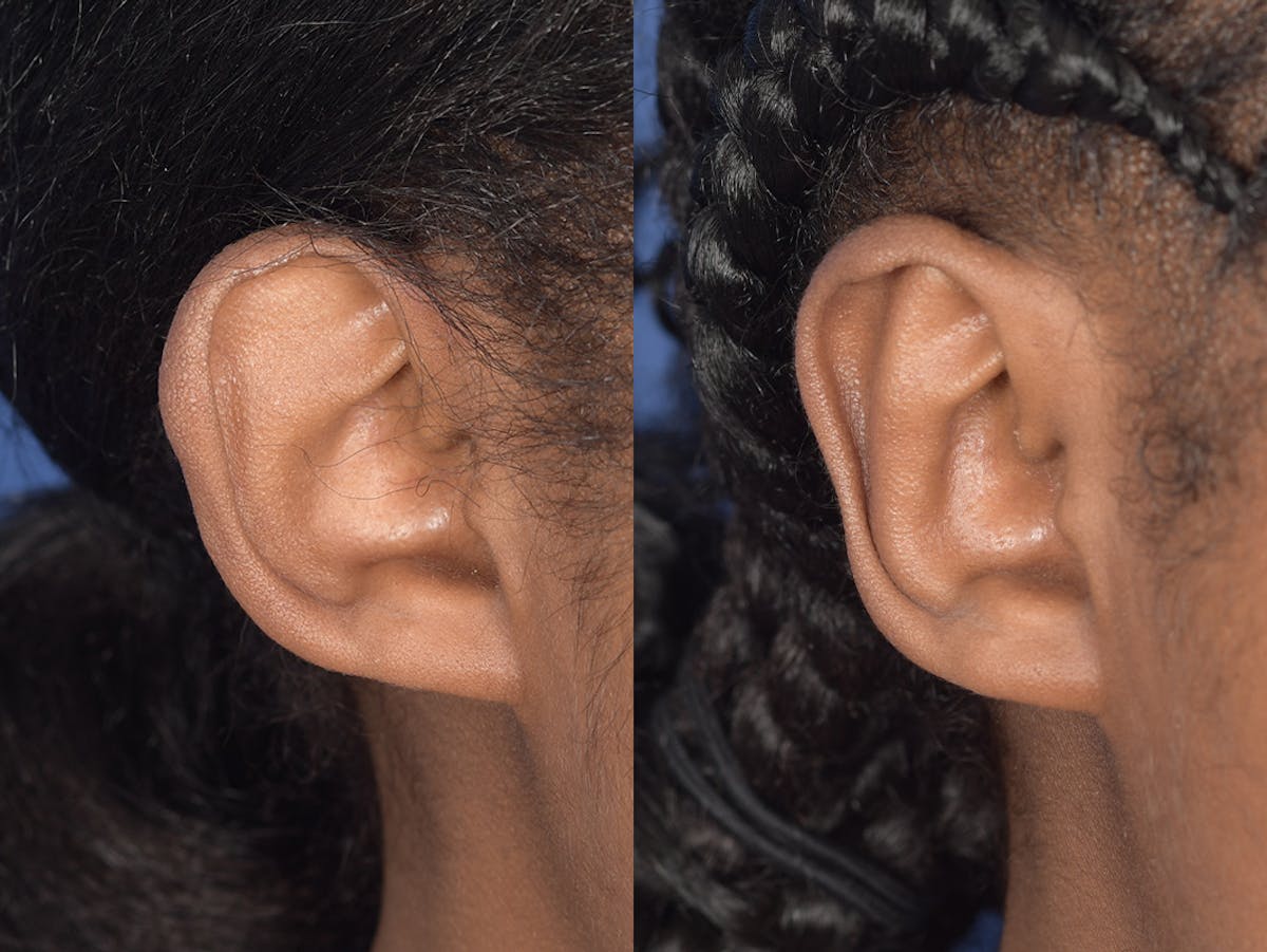 Otoplasty Before & After Gallery - Patient 221385 - Image 5