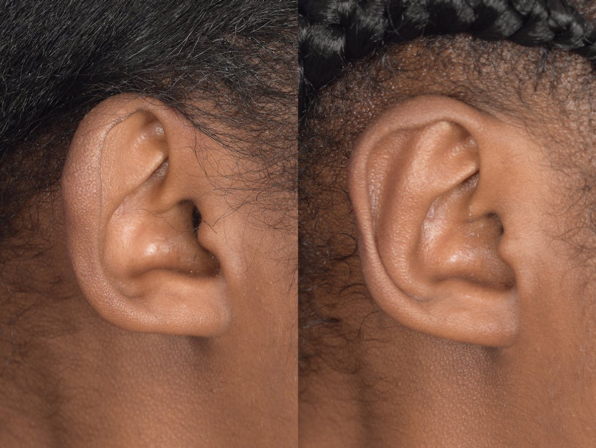 Otoplasty Before & After Gallery - Patient 221385 - Image 6