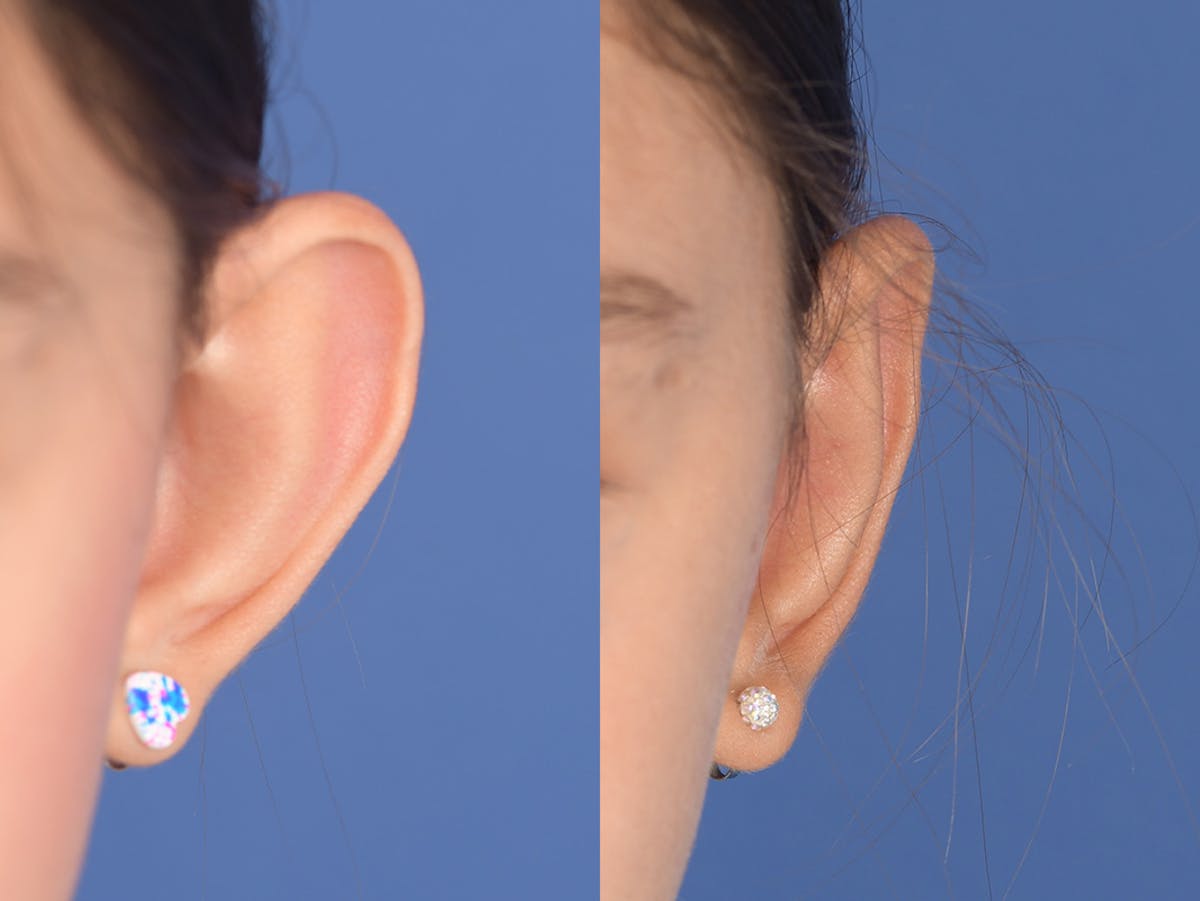 Otoplasty Before & After Gallery - Patient 185435 - Image 1