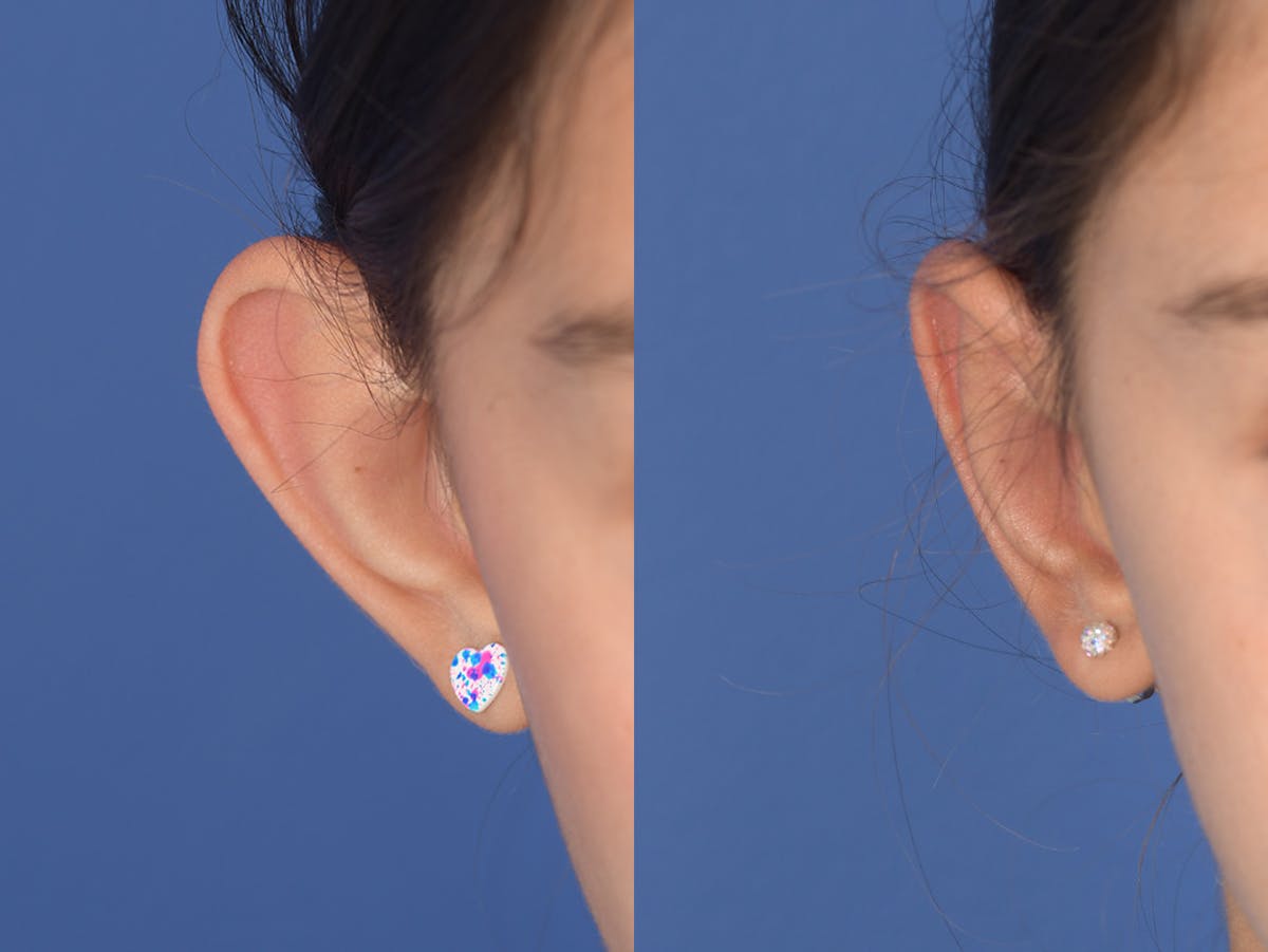 Otoplasty Before & After Gallery - Patient 185435 - Image 2