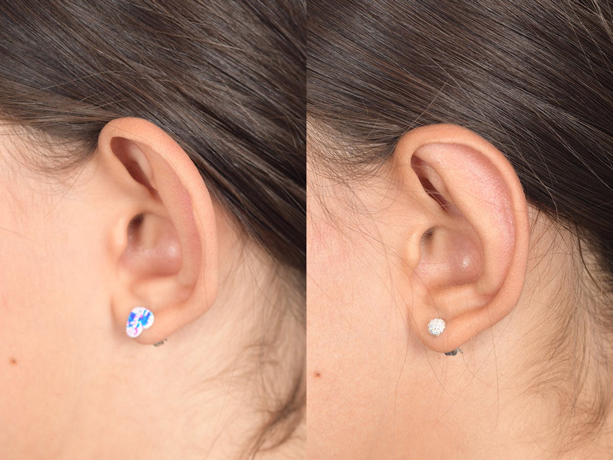 Otoplasty Before & After Gallery - Patient 185435 - Image 3