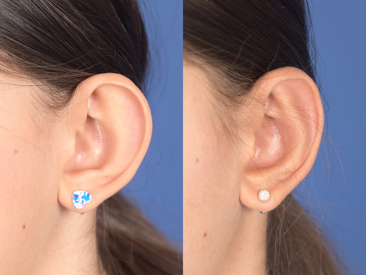 Otoplasty Before & After Gallery - Patient 185435 - Image 4