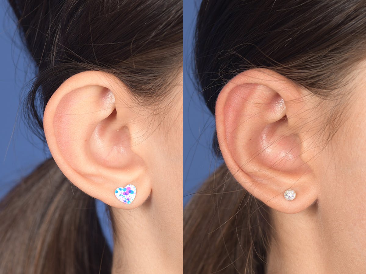 Otoplasty Before & After Gallery - Patient 185435 - Image 5