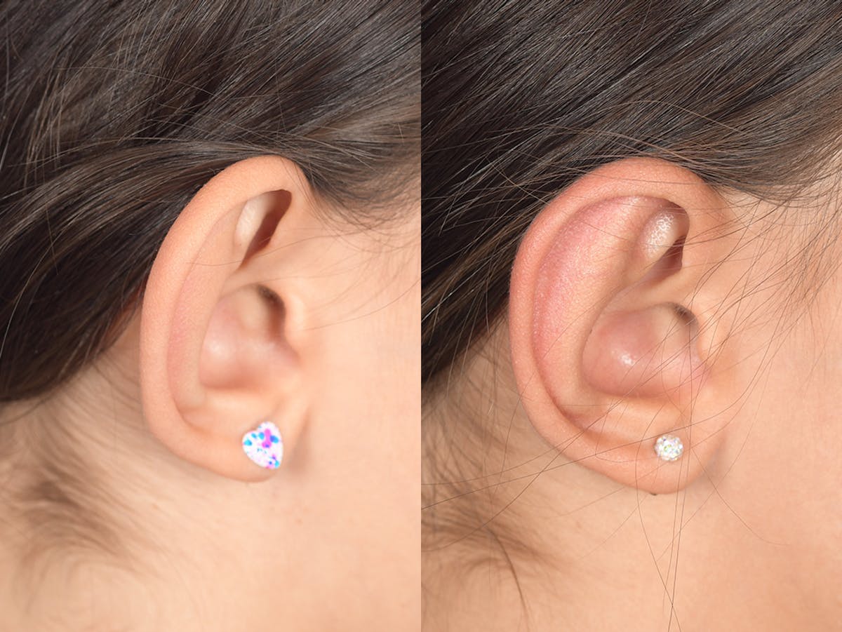 Otoplasty Before & After Gallery - Patient 185435 - Image 6