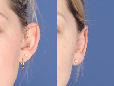 Otoplasty Before & After Gallery - Patient 330713 - Image 1